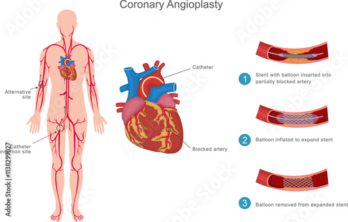 Coronary angioplasty is a minimally invasive procedure to open blocked heart arteries using a balloon and stent, improving blood flow and reducing heart attack risk