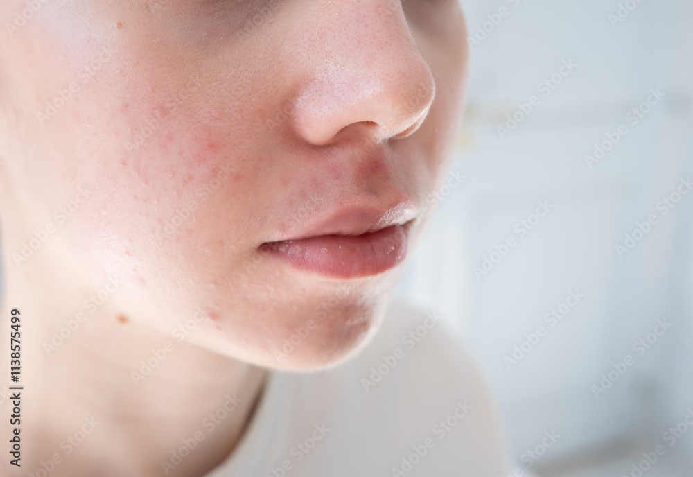 Obraz premium Close up of young woman with acne and post-acne marks on her cheeks. Hormonal acne, puberty and before menstruation, adult acne, rosacea. 
