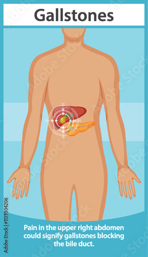 Understanding Gallstones and Their Symptoms