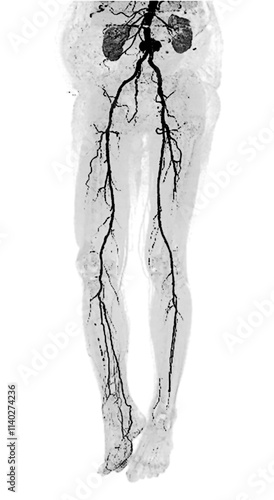 3D CTA of Lower Extremities:.A clear 3D visualization of the femoral artery and lower body skeleton, supporting vascular and orthopedic assessment. photo