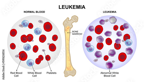 Leukemia Blood Cancer Illustration