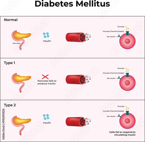 Diabetes Mellitus Design Vector Illustration
