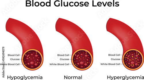 Blood Glucose Levels Hypoglycemia Normal Hypoglycemia Design Vector Illustration