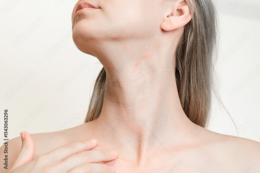 View on woman's neck with red spots isolated. Atopic dermatitis, psoriasis or eczema, inflammatory or allergies View on woman's neck with red spots isolated. Atopic dermatitis, psoriasis or eczema, inflammatory or allergies