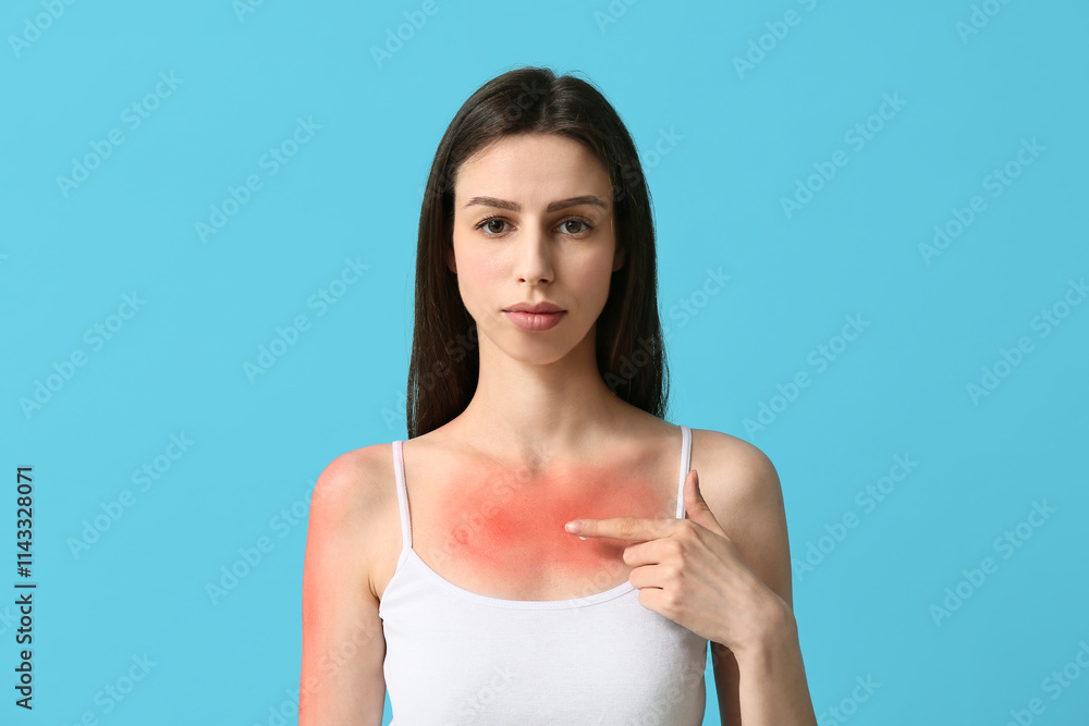 Young woman with red sunburned skin applying cream on blue background Young woman with red sunburned skin applying cream on blue background