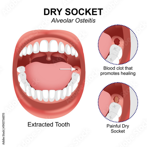 Alveolar Osteitis Dry Socket
