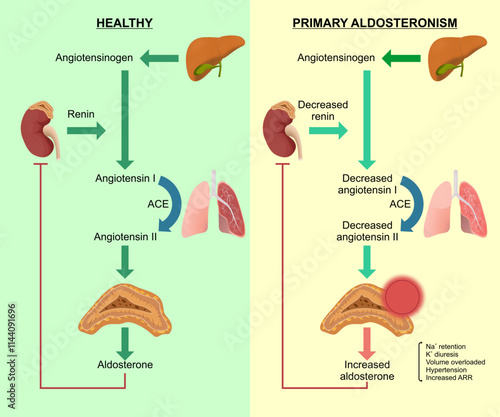 Aldosteronoma Healthy and primary aldosteronoma