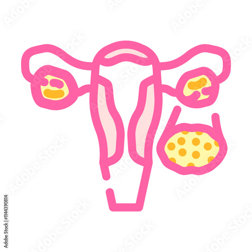 polycystic ovary syndrome woman disease color icon vector. polycystic ovary syndrome woman disease sign. isolated symbol illustration