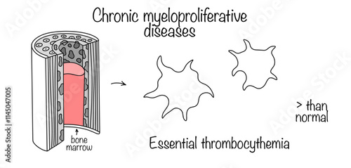 Essential thrombocythemia