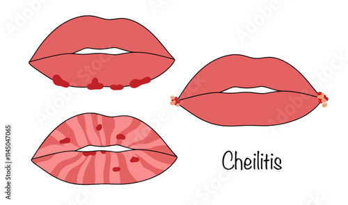 Cheilitis