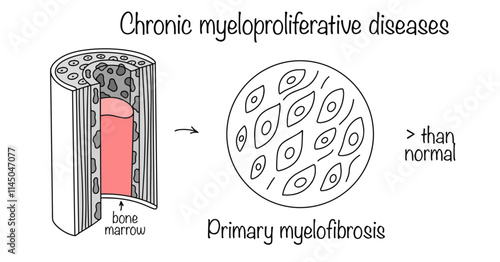 Primary myelofibrosis