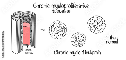 Chronic myeloid leukemia