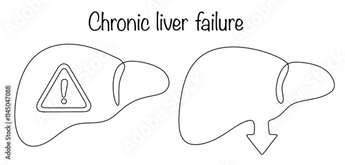 Chronic liver failure