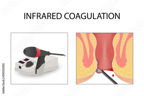 Infrared coagulation for hemorrhoids. Medical instruments, healthcare