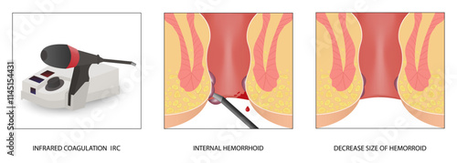 Infrared photocoagulation of hemorrhoids. Colon cancer, examination, rectal pain