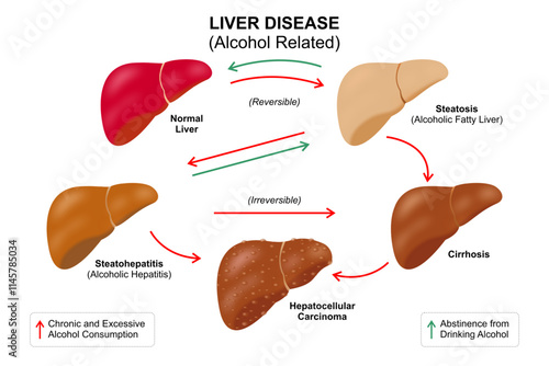 Alcohol Related Liver Disease Illustration