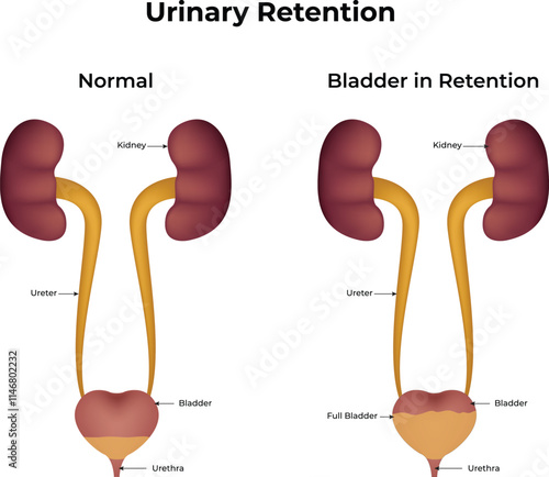 Urinary Retention Normal Bladder in Retention Design Vector Illustration