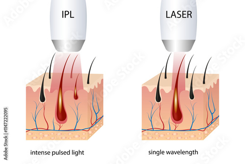 IPL (Intense Pulsed Light) and Laser Hair Removal. Differences in Hair Removal, Skin Conditions During Treatment Session