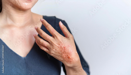 Discoid eczema is a chronic skin condition that causes skin