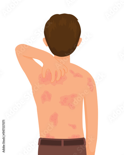 young man scratching his itchy back with rash, allergy, dermatitis, skin inflammation, redness and irritation