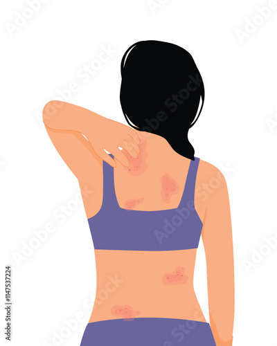 young woman scratching her itchy back with rash, allergy, dermatitis, skin inflammation, redness and irritation