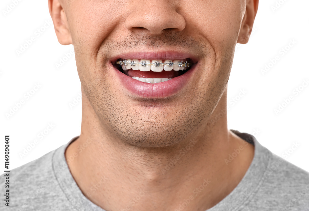 Obraz premium Smiling man with dental braces on white background, closeup
