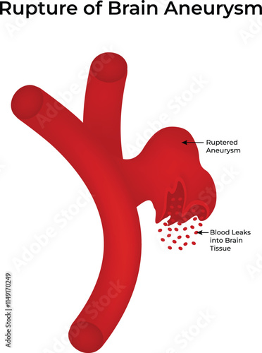 Rupture of Brain Aneurysm Science Design Vector Illustration Diagram
