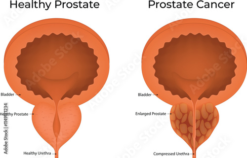 Healthy Prostate and Prostate Cancer Science Design Vector Illustration Diagram