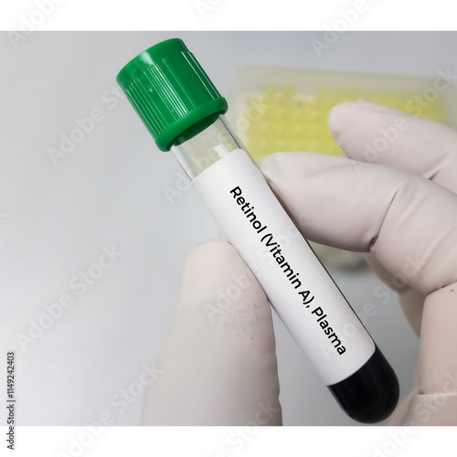 Blood sample for Vitamin A or Retinol test to diagnosis of vitamin A deficiency. photo