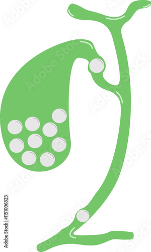 Gallstones in the Gallbladder and Bile Duct