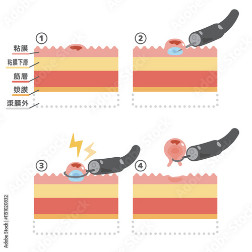 内視鏡治療　EMRのイラスト