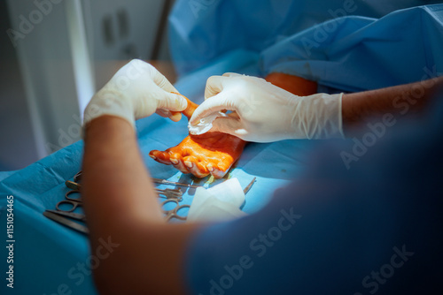 Surgeon Uses Gauze to Stop Bleeding After Surgery Before Its Completion. Orthopedist performing arm surgery in the operating room 
