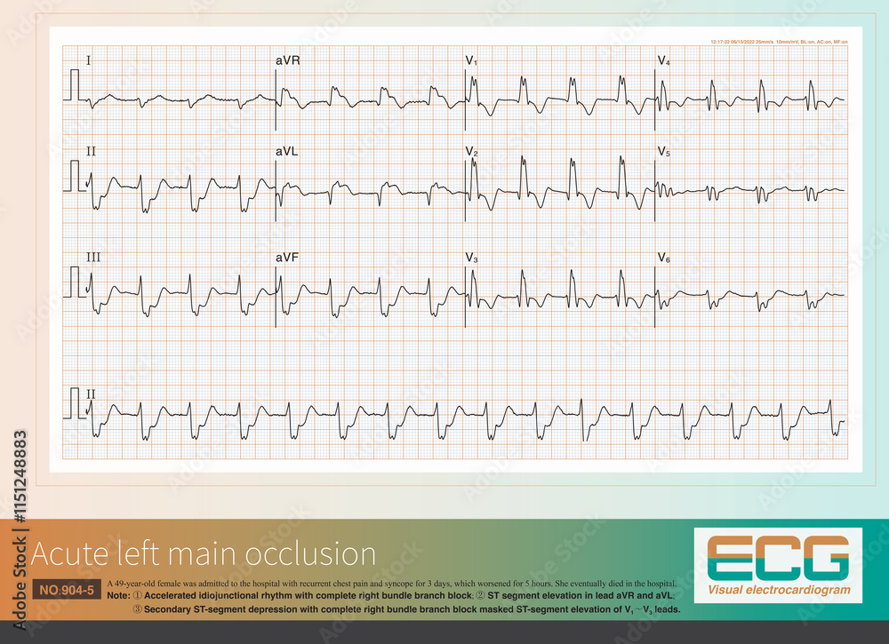 Poster When acute left main artery occlusion causes ST segment ...