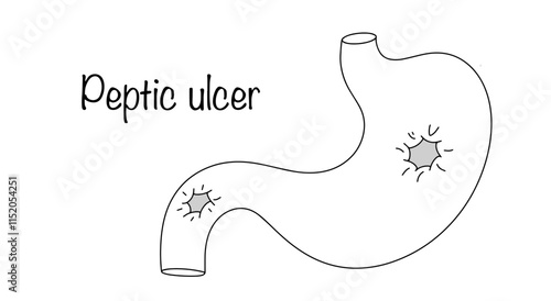 Peptic ulcer