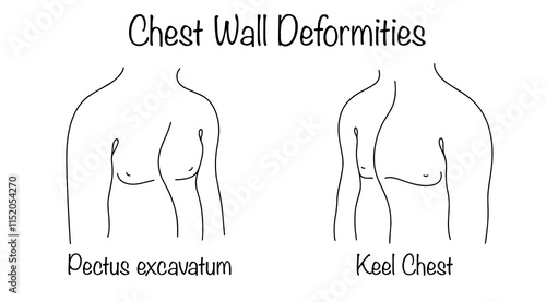 Chest Wall Deformities