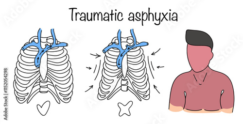 Traumatic asphyxia
