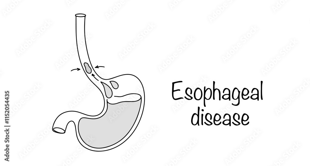 Obraz premium Esophageal disease