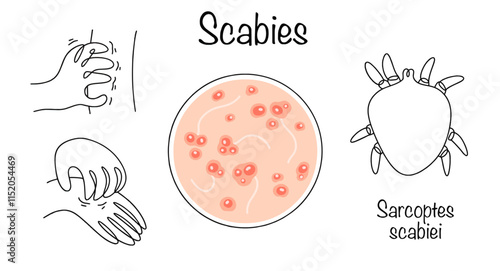 Scabies