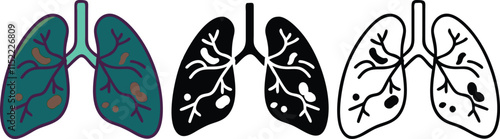 Diseased Lungs Illustrations of Pulmonary Infections, Bronchitis, and Emphysema