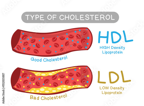 HDL (Good cholesterol) and LDL (Bad cholesterol) in blood vessels - Type of Cholesterol