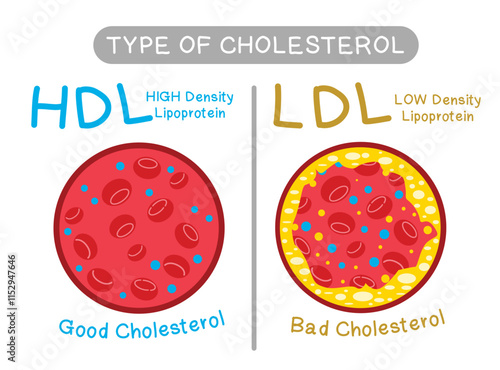 Cholesterol in blood vessels with HDL and LDL lipoproteins of normal arteries and narrowed arteries - Type of Cholesterol, Vector illustration