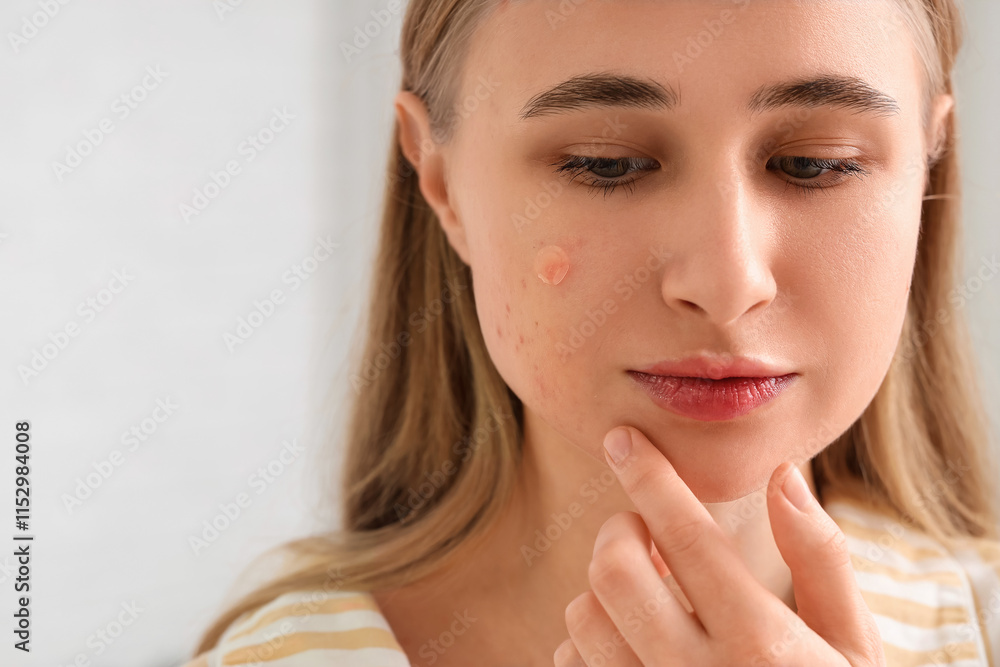 Young woman with acne problem and pimple patch on light background, closeup Young woman with acne problem and pimple patch on light background, closeup