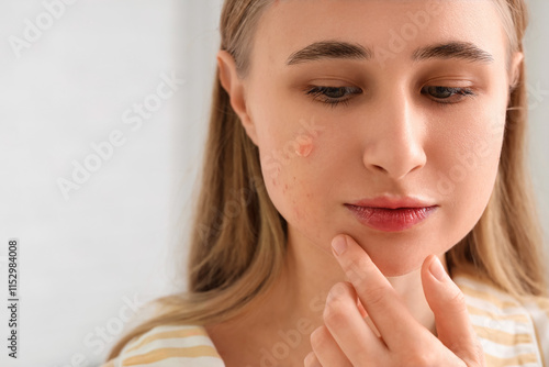Young woman with acne problem and pimple patch on light background, closeup