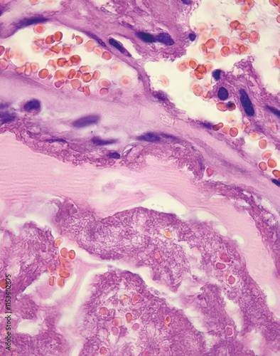 This photo shows the pink myxoid stroma of an atrial myxoma, with cords of myxoma cells and focal hemorrhages of red blood cells.Magnify 1000x. photo