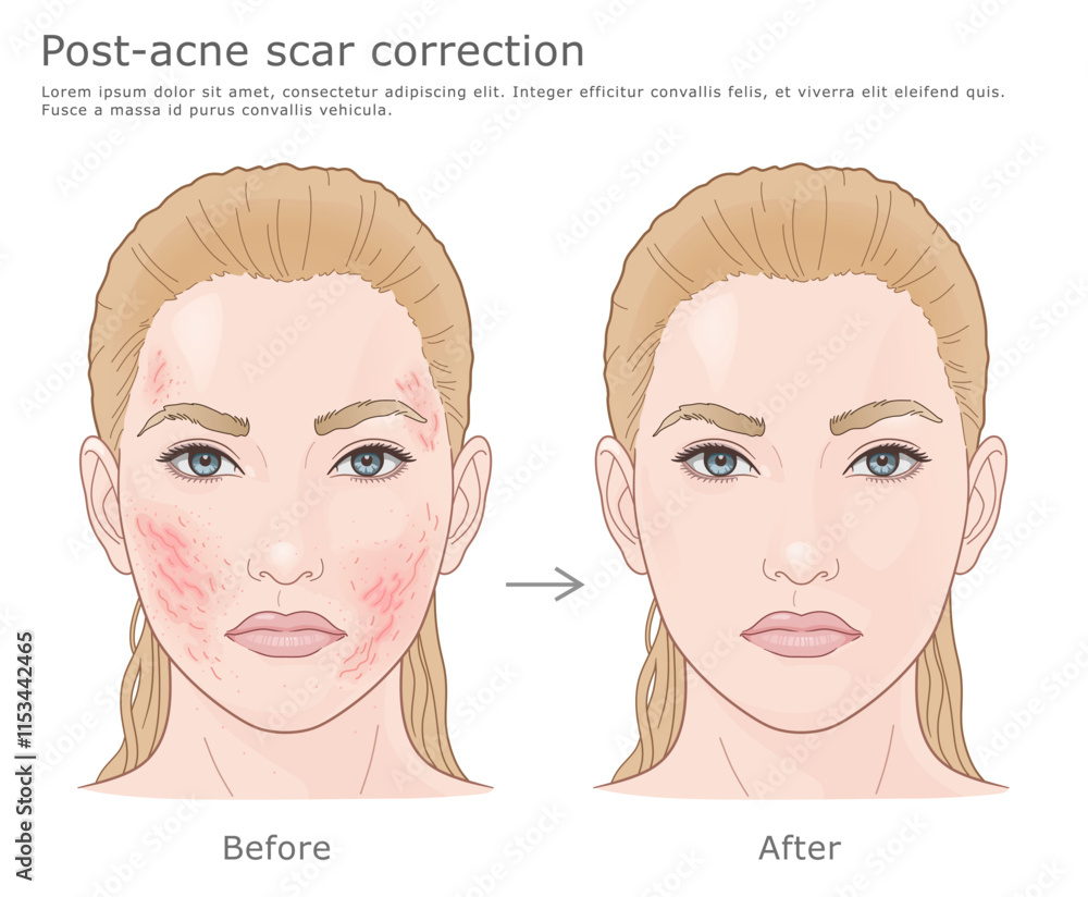 Medical vector illustration of acne scar correction. Before and after.