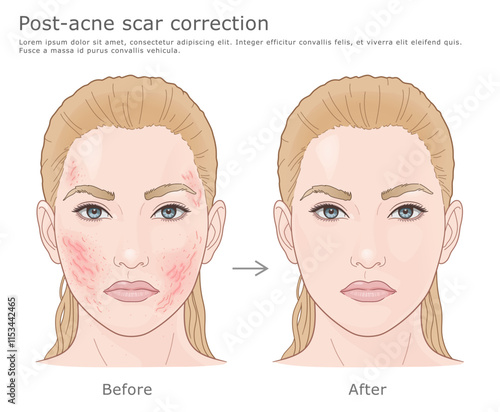 Medical vector illustration of acne scar correction. Before and after.