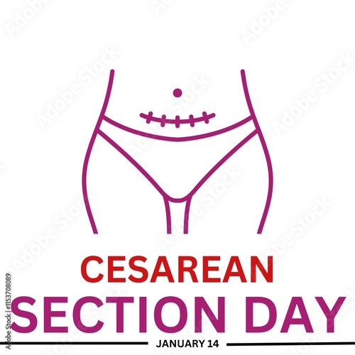 cesarean section day  photo