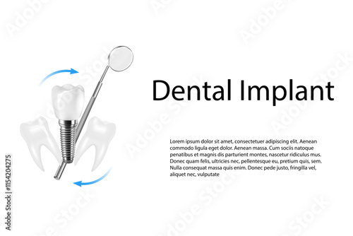 3D realistic composition of dental implantation. Illustration of dental activity.