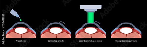 LASIK eye surgery