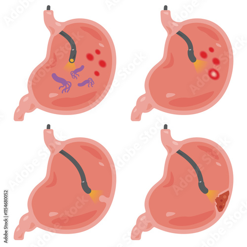 胃カメラ検査を受ける色々な状態の胃のイラストセット